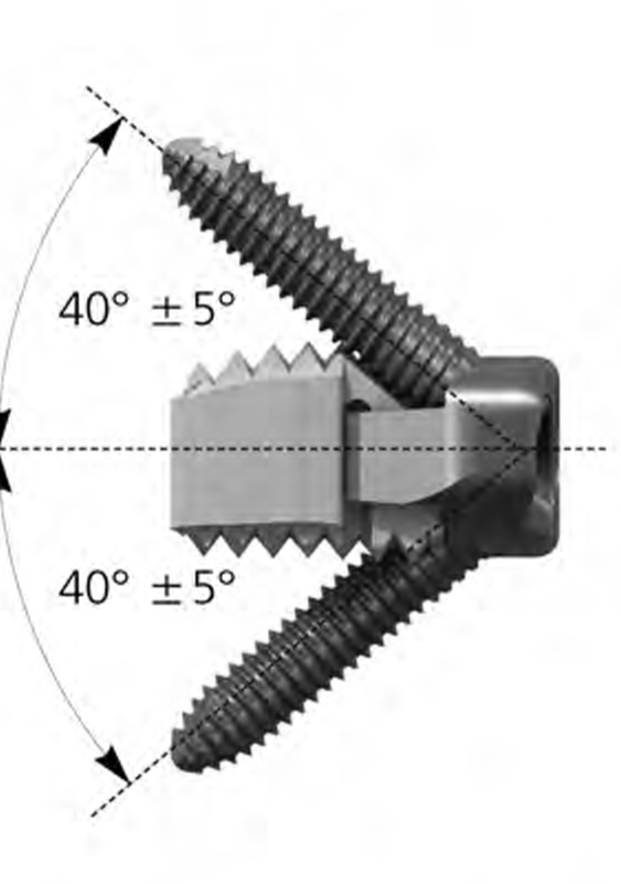 Шийний кейдж для переднього спондилодезу